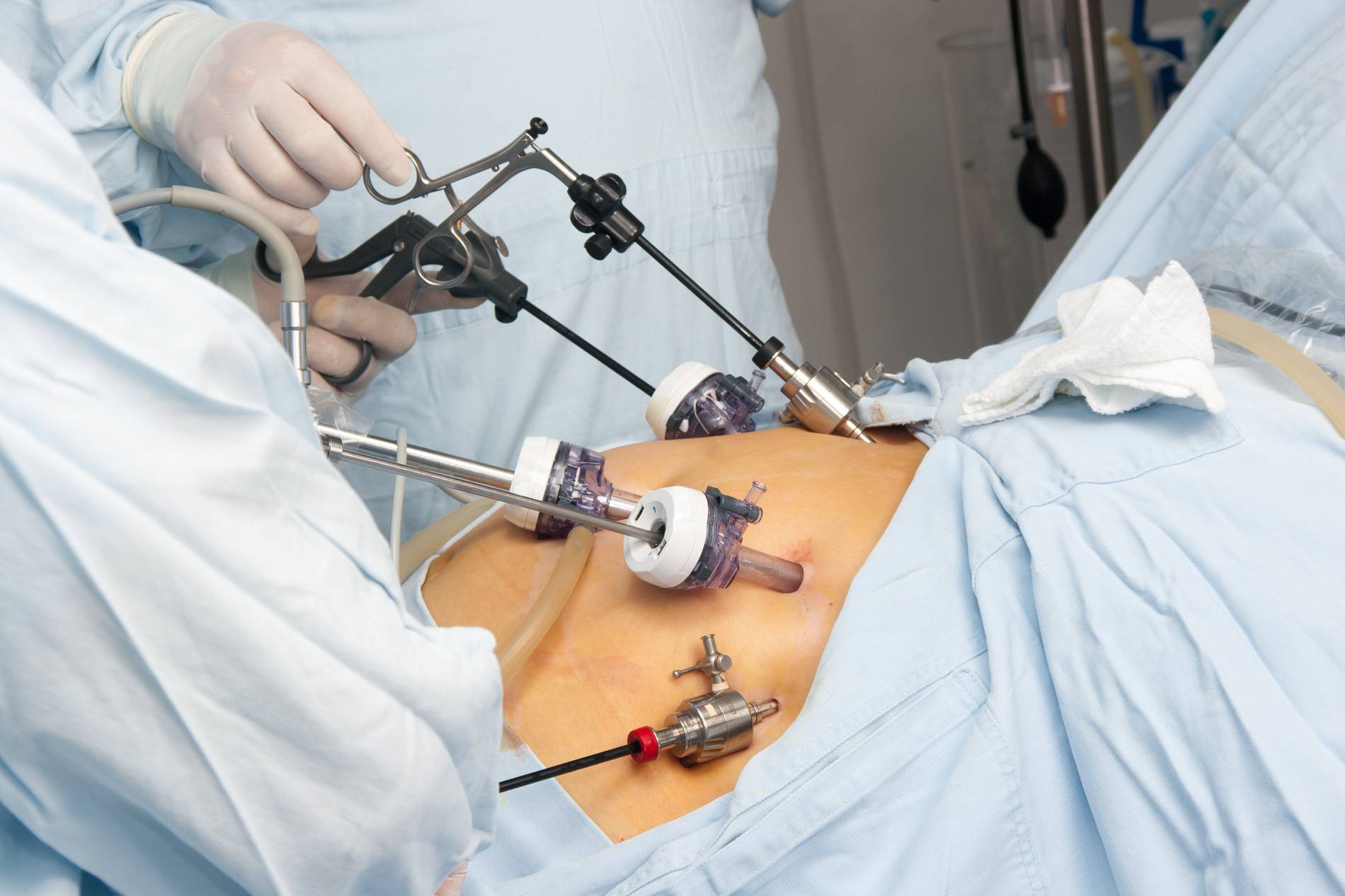 Warum immer mehr Patienten eine Magen Op Türkei wählen